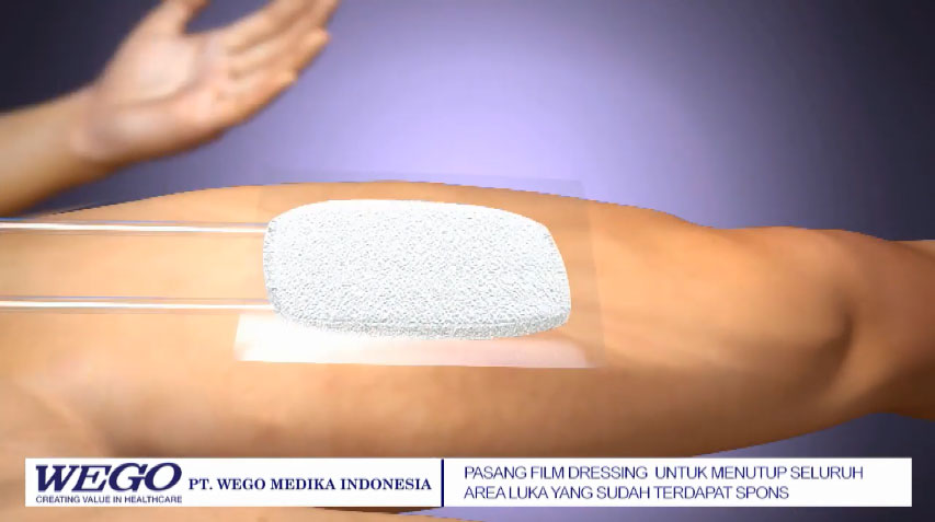 Tutorial pemasangan dressing NPWT Wego Medika Indonesia