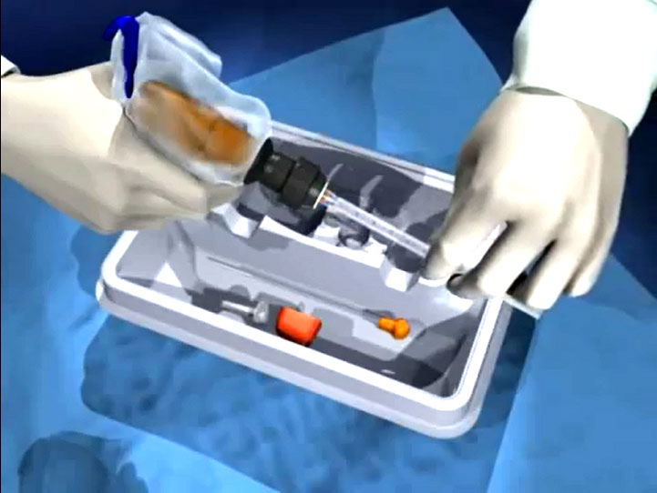 OnControl Bone Marrow Biopsy and Aspiration System Works