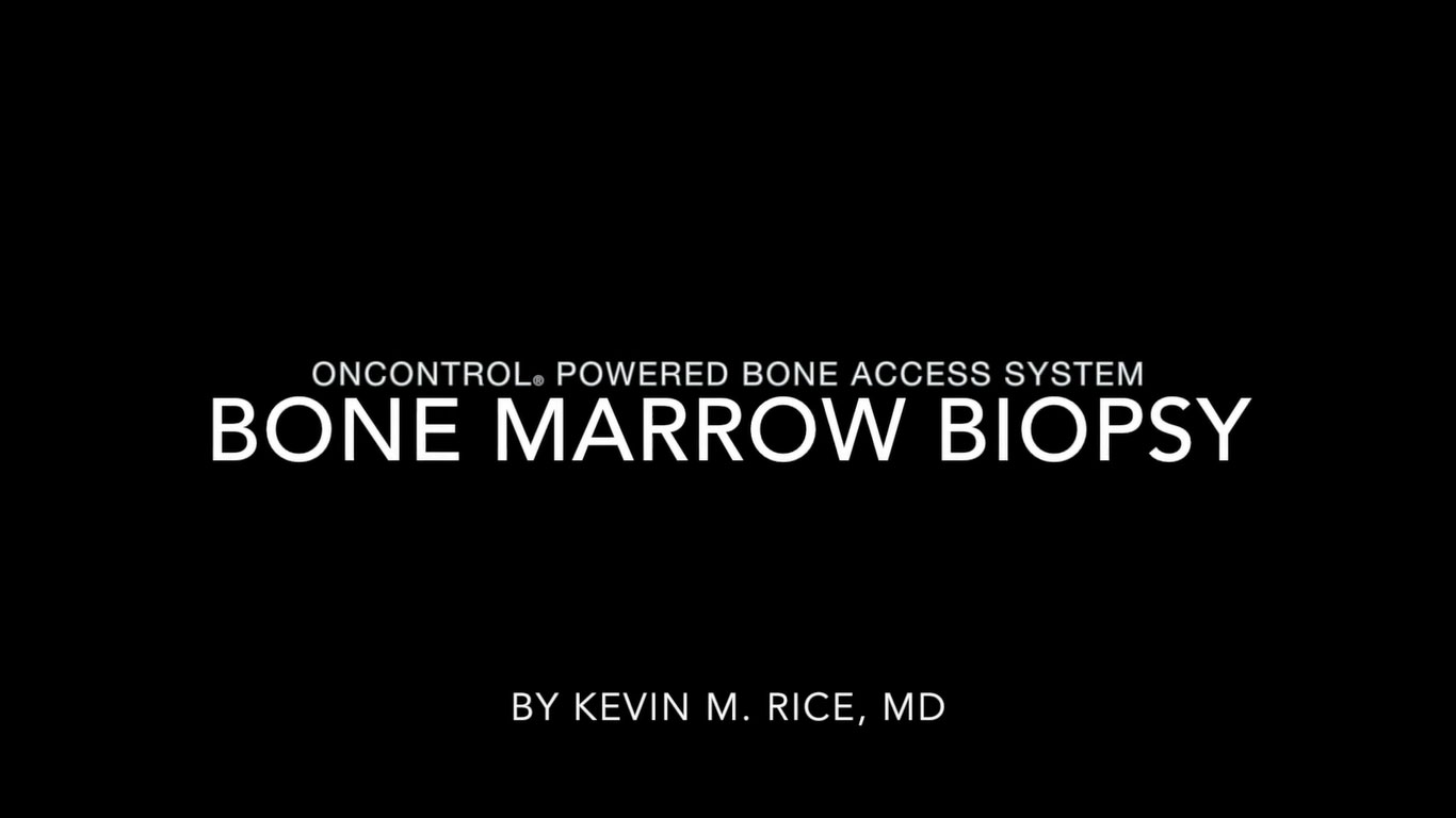 ALMOST PAINLESS BONE MARROW BIOPSY WITH ONCONTROL POWERED BONE ACCESS SYSTEM