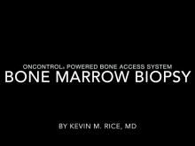 ALMOST PAINLESS BONE MARROW BIOPSY WITH ONCONTROL POWERED BONE ACCESS SYSTEM